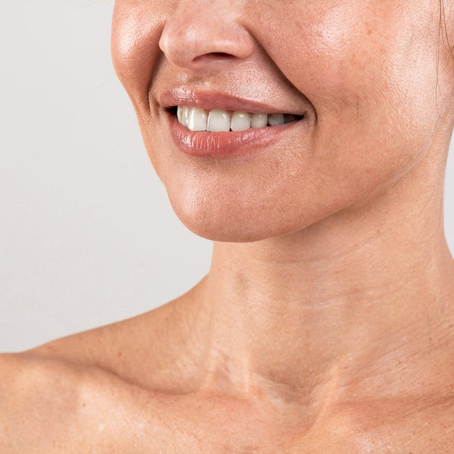 Erase Marionette Lines Naturally—No Needles Needed