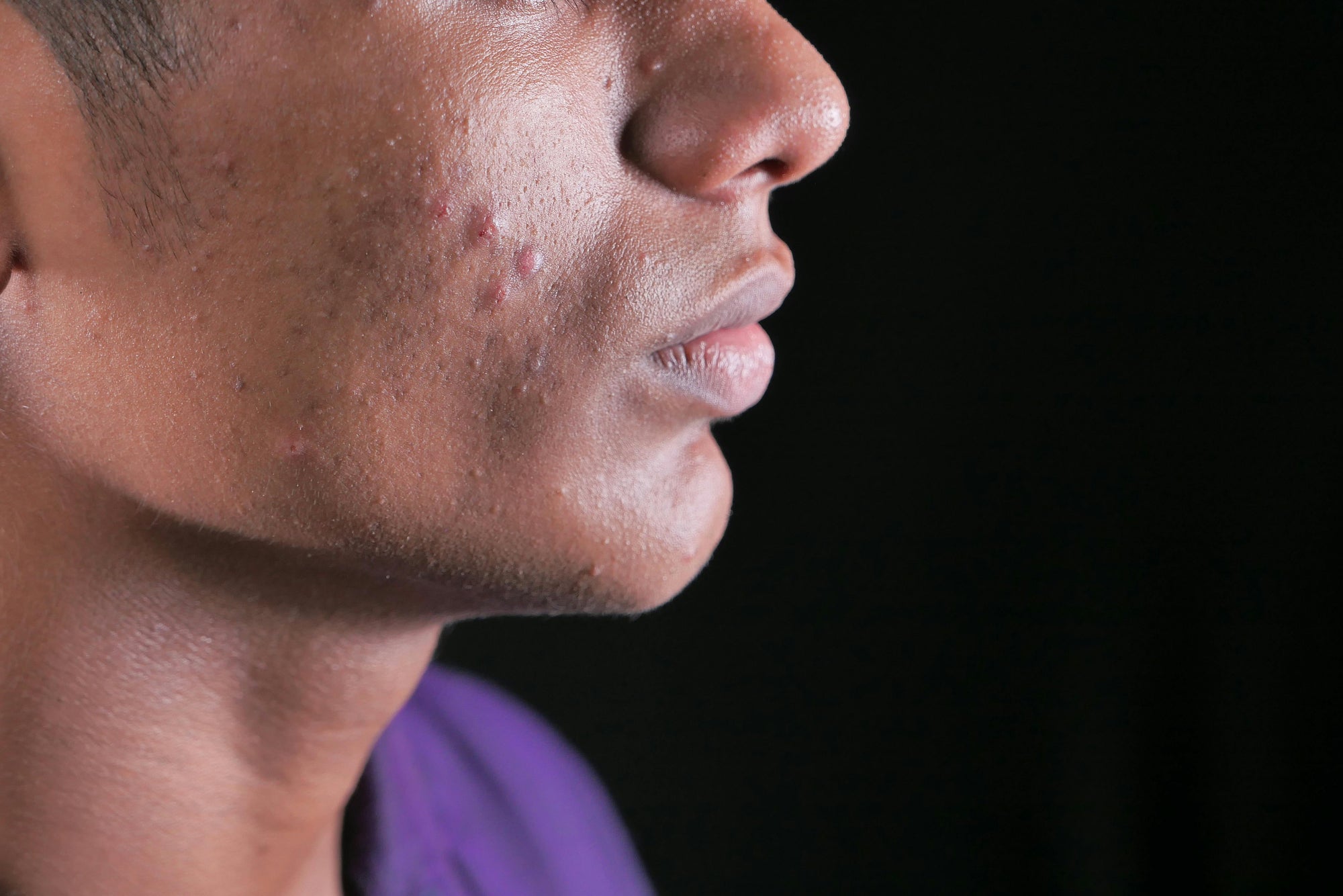 Best Cleanser for Oily Skin: A Quick Guide
