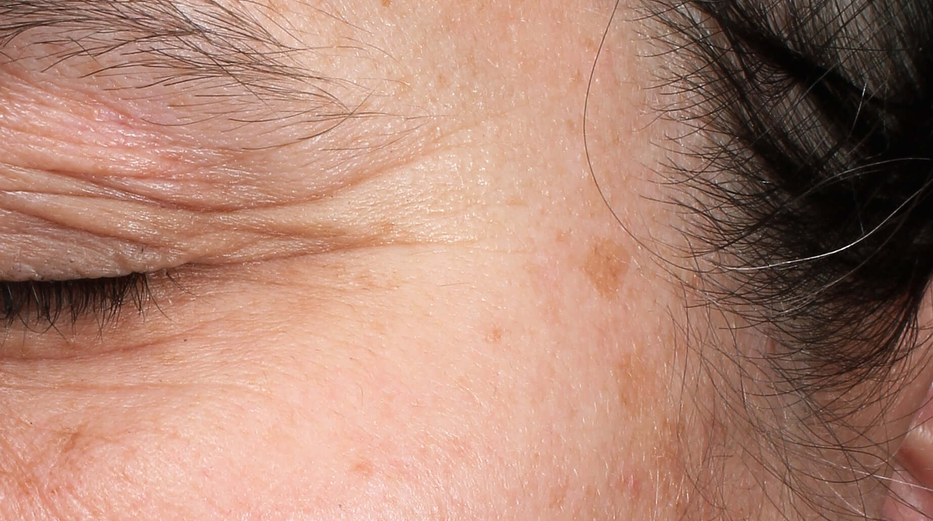 Before using CELF Rejuvenation Station - CELF is proven to dramatically reduce wrinkles microvibration therapy skincare CELF