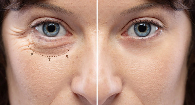 Best Non-Invasive Treatments for Under-Eye Bags