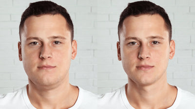 Facial Volume Loss: Why Faces Look Different Over Time