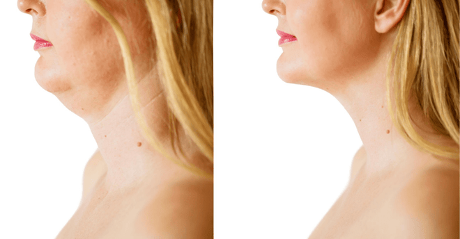 Non-Surgical Chin & Jawline Slimming for Round Faces