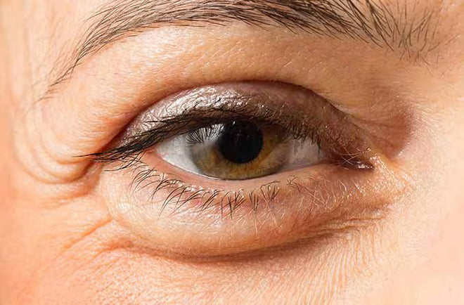 What Are the Causes of Under-Eye Swelling and How Can You Tell What’s Normal vs. Concerning?