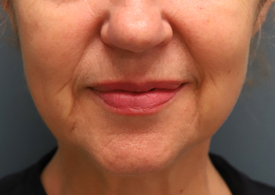 What Causes Wrinkles Around the Mouth and How Can You Prevent Them?