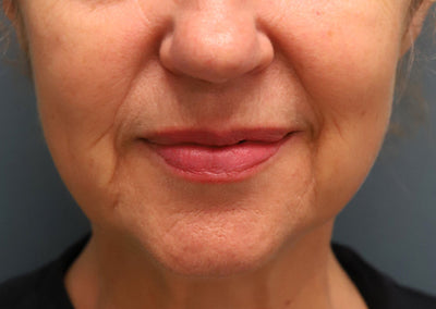 What Causes Wrinkles Around the Mouth and How Can You Prevent Them?
