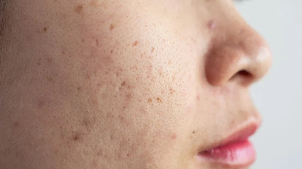 LED Light Therapy for Hyperpigmentation: Does It Really Work?