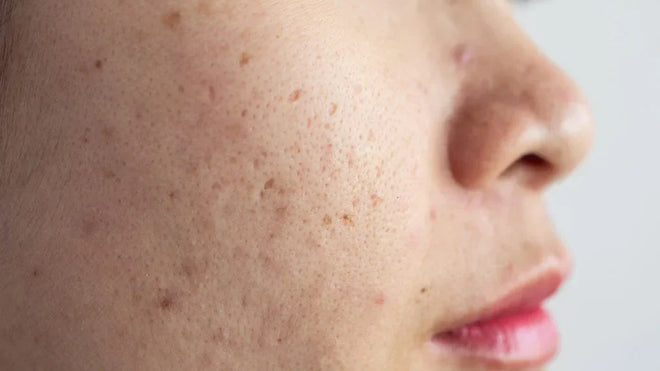 LED Light Therapy for Hyperpigmentation: Does It Really Work?