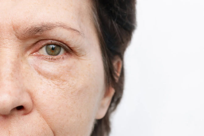 Under-Eye Puffiness After Weight Loss: What Helps?
